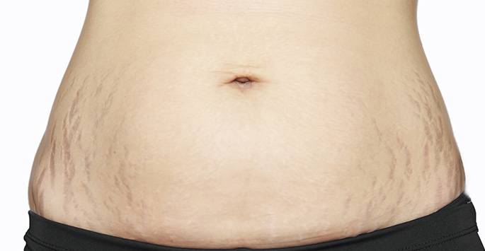 stretchmarks