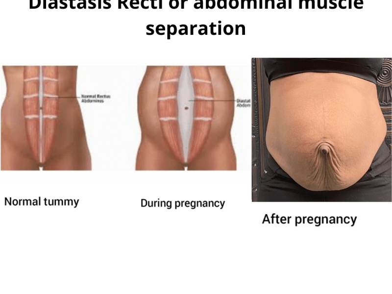 Did you go through rehabilitation after&nbsp;Childbirth?